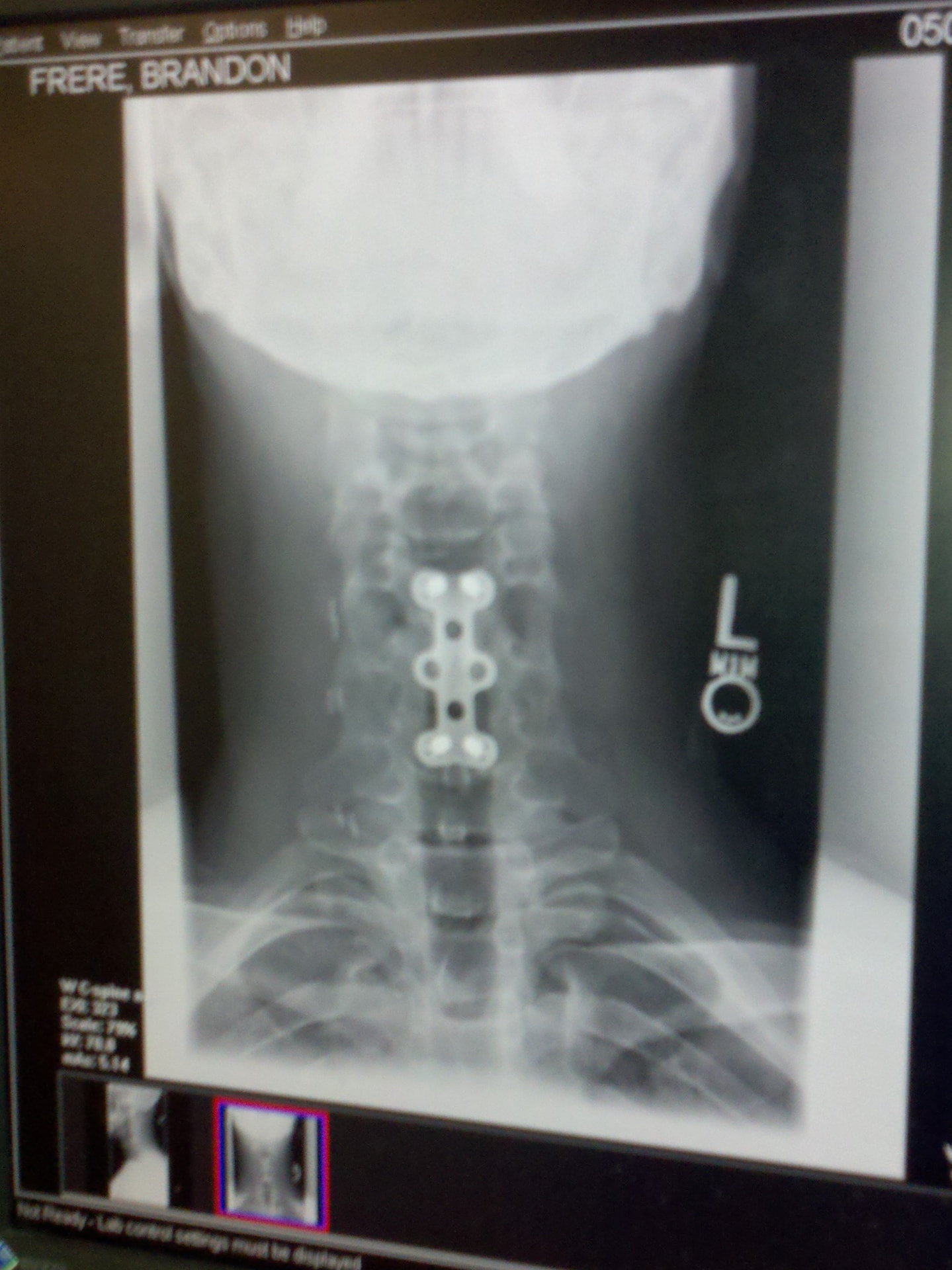 Cervical spine X-ray after the dirt-bike accident